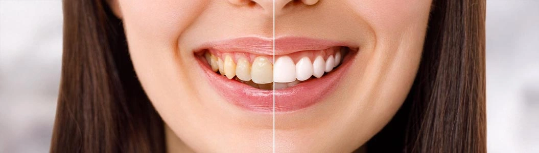 Diş Beyazlatma İşlemi