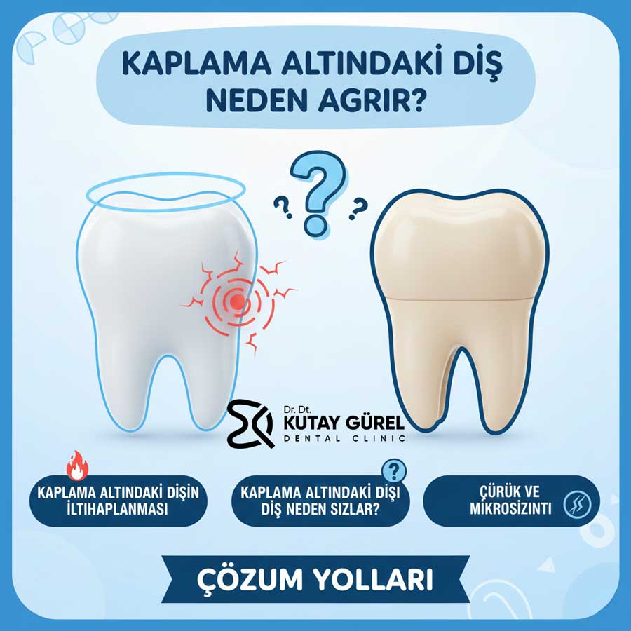Kaplamanın Altındaki Diş Ağrısına Ne İyi Gelir?