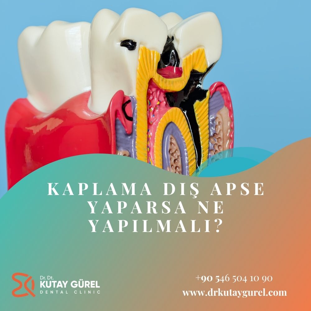 Kaplama Diş Apse Yaparsa Ne Yapılmalı?