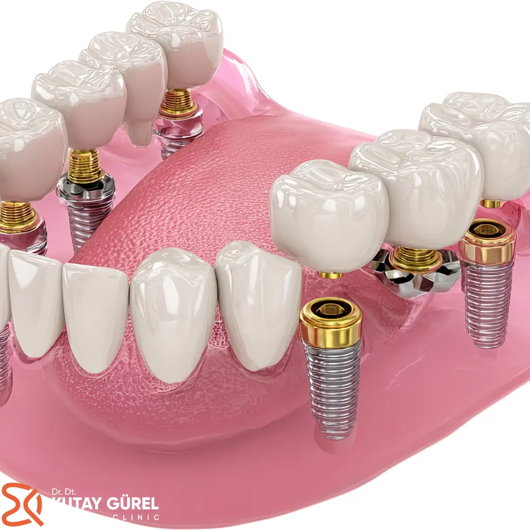 İzmir Çiğli - All on Six İmplant Diş  Tedavisi