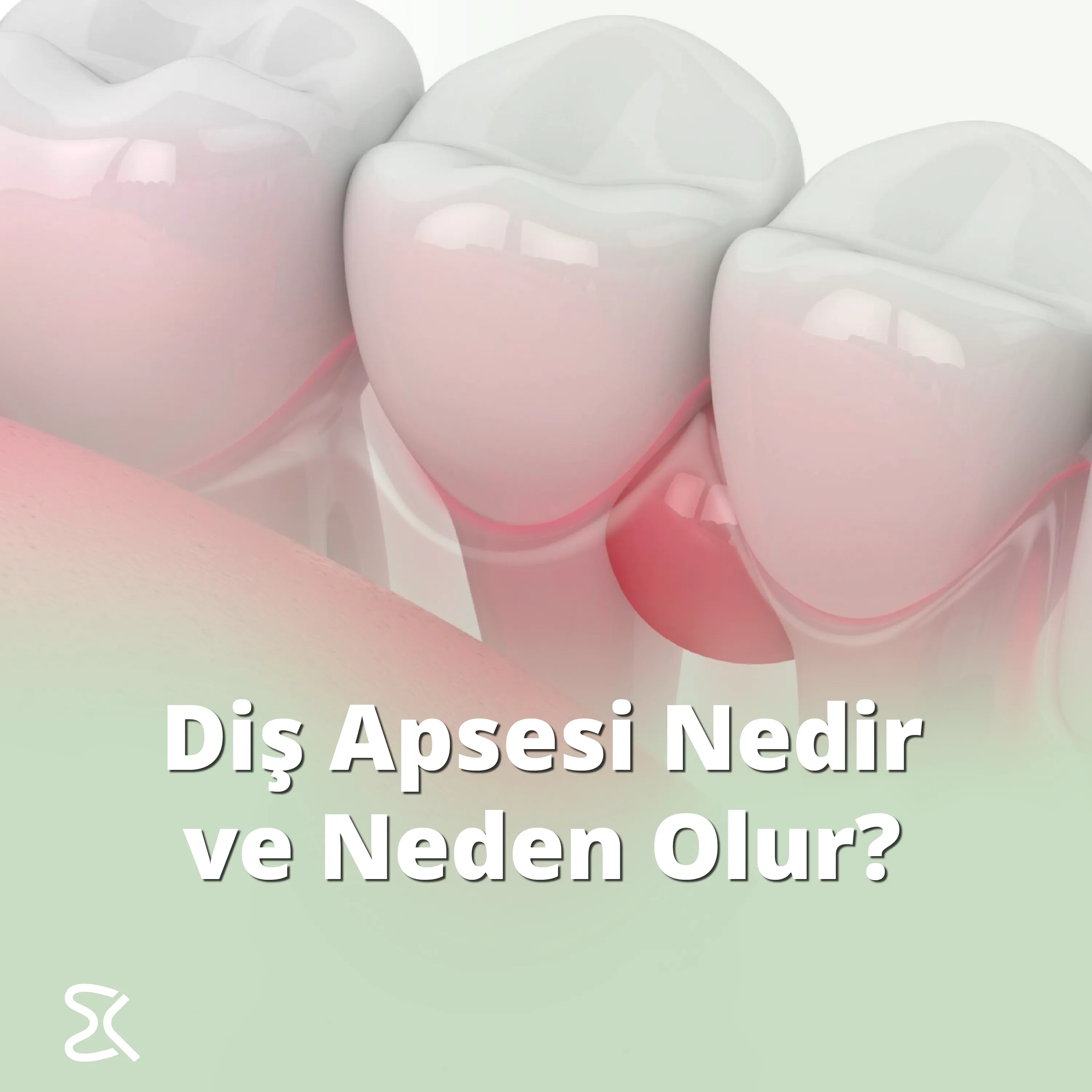 Diş Apsesi Nedir ve Neden Olur?
