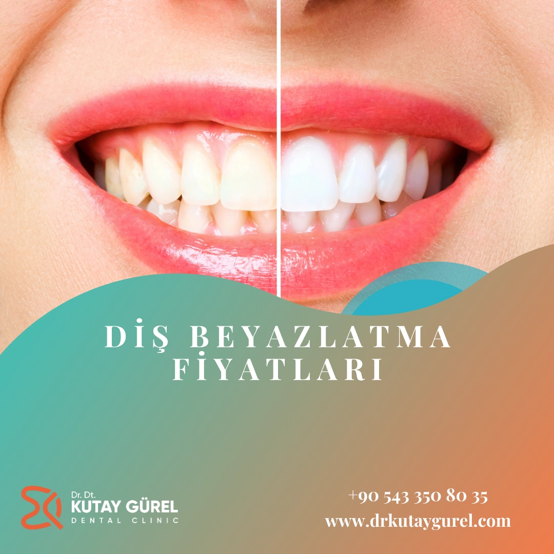 Diş Beyazlatma Fiyatları
