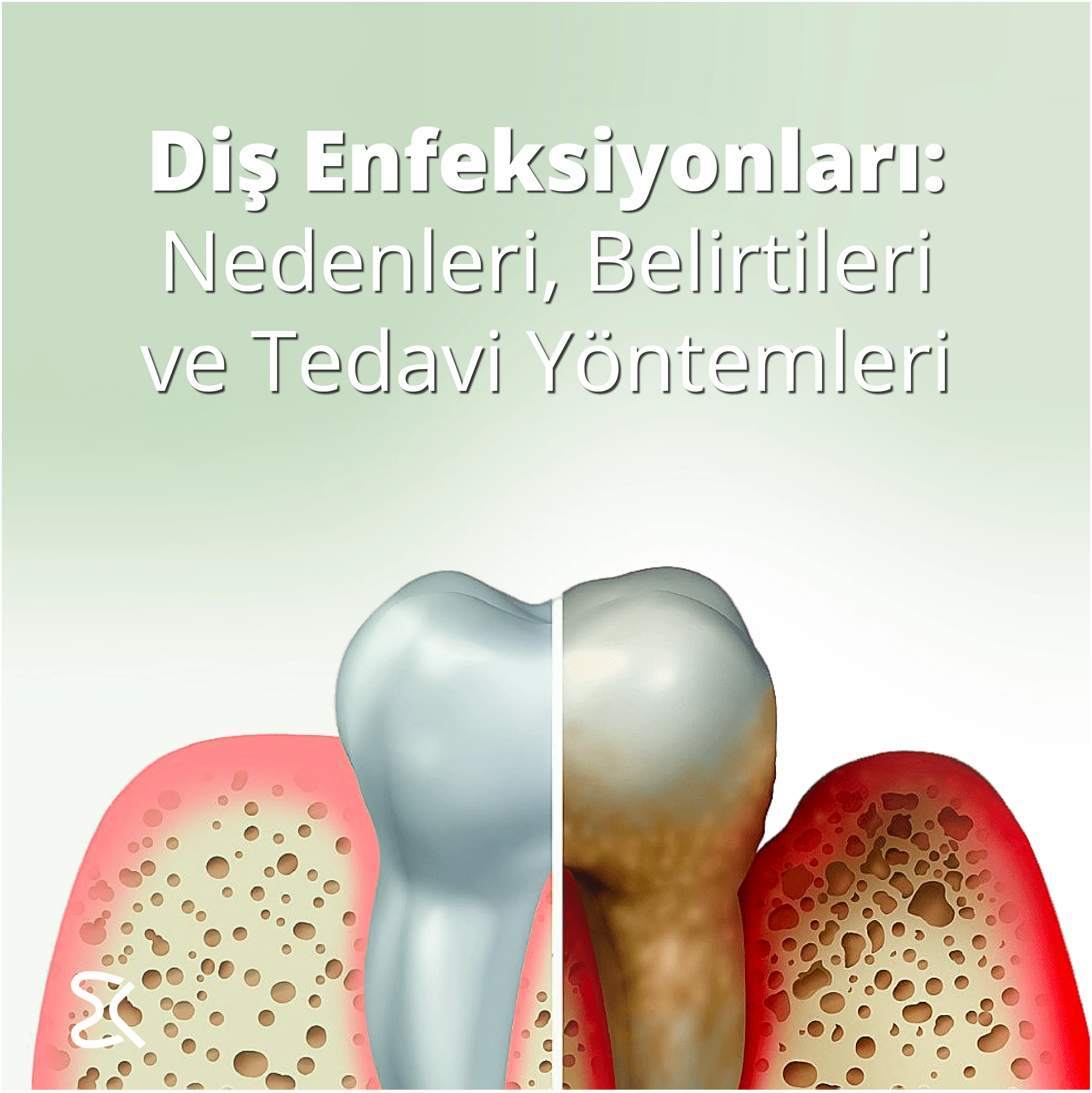 Diş Enfeksiyonları: Nedenleri, Belirtileri ve Tedavi Yöntemleri Çiğli  İzmir.