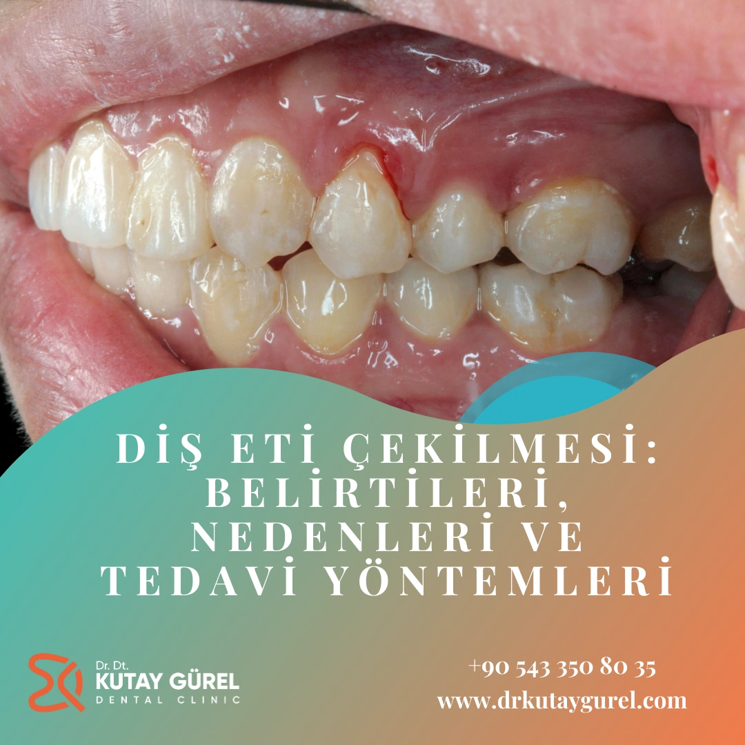 Diş Eti Çekilmesi