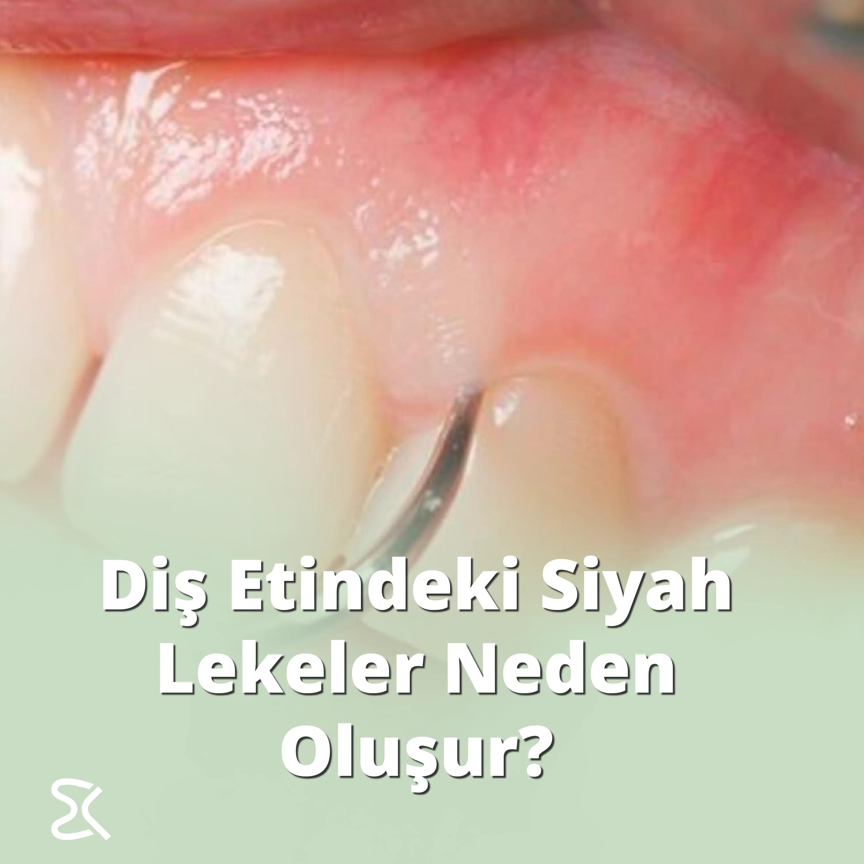 Diş Etindeki Siyah Lekeler Neden Oluşur?