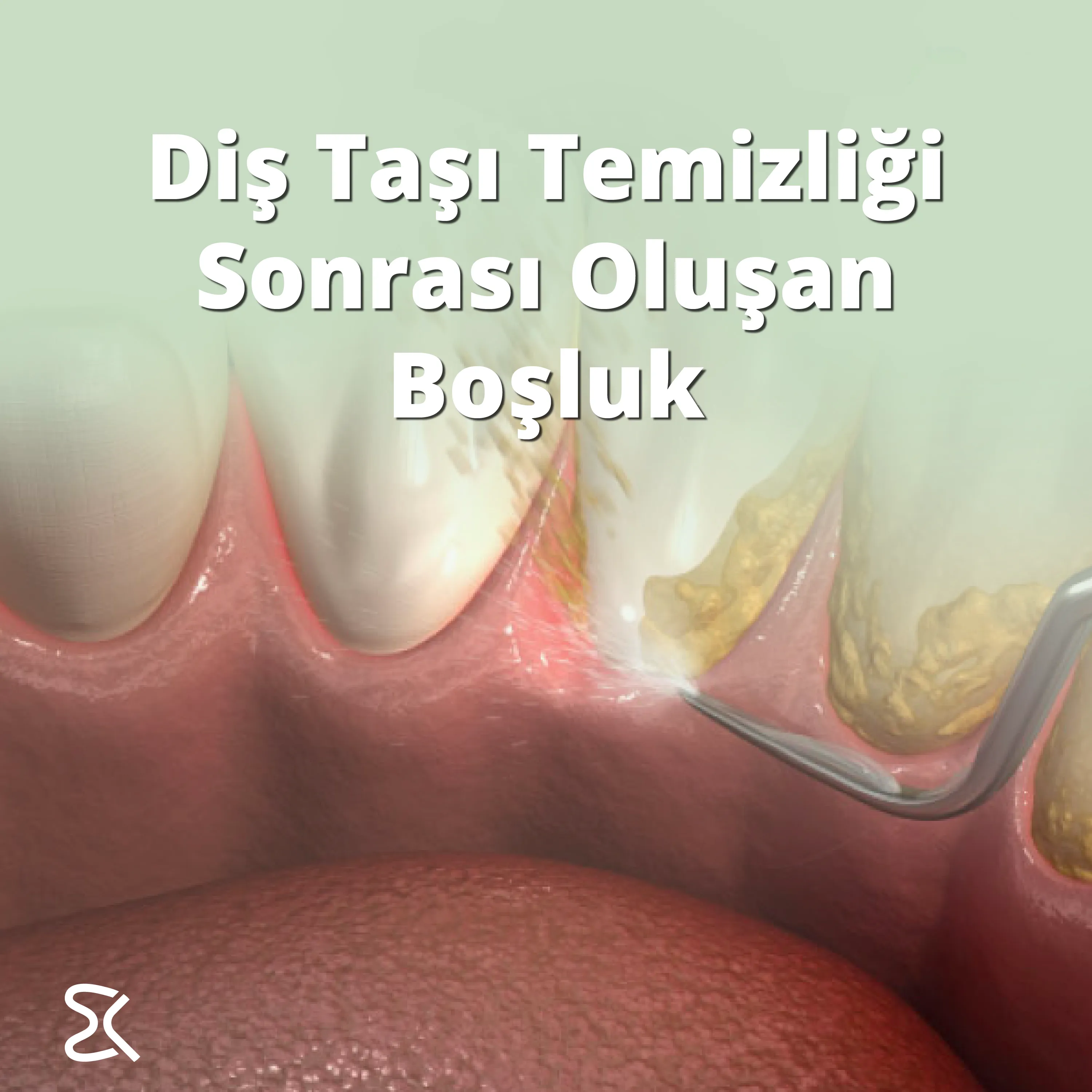 Diş Taşı Temizliği Sonrası Oluşan Boşluk