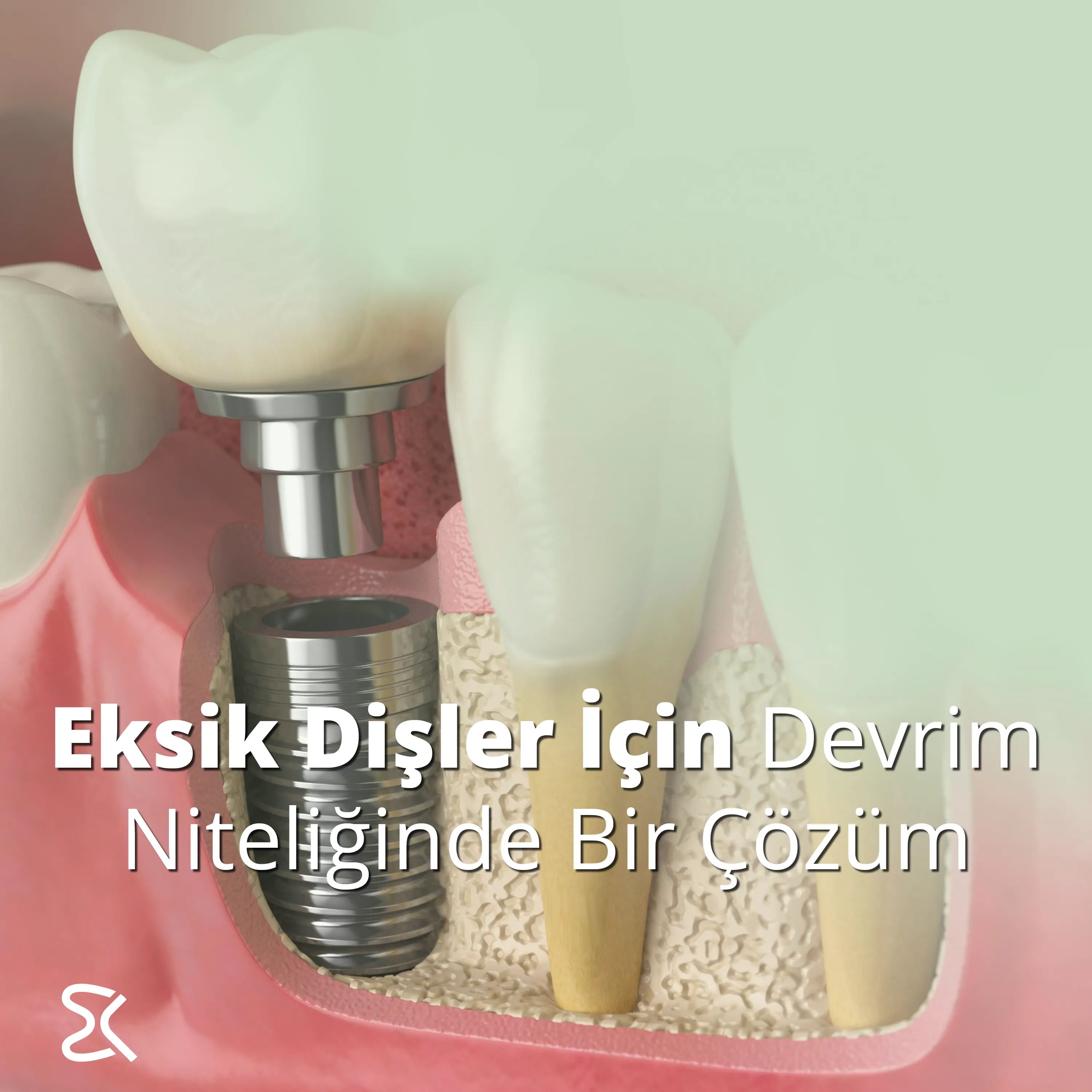 İzmir İmplant Diş: Eksik Dişler İçin Devrim Niteliğinde Bir Çözüm ve En Merak Edilenler Çiğli