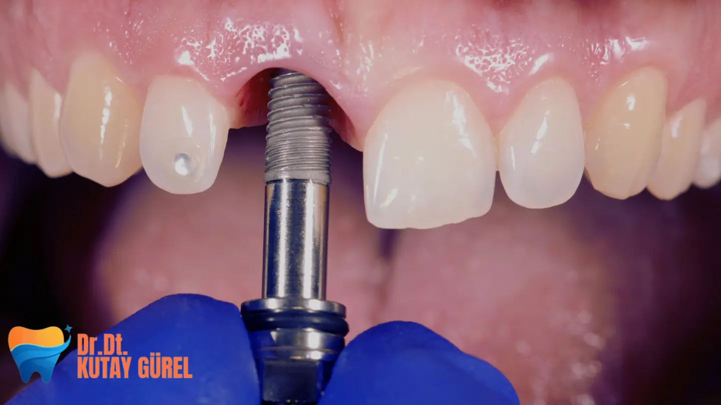İzmir Çiğli Diş İmplantları Hakkında Merak Edilenler