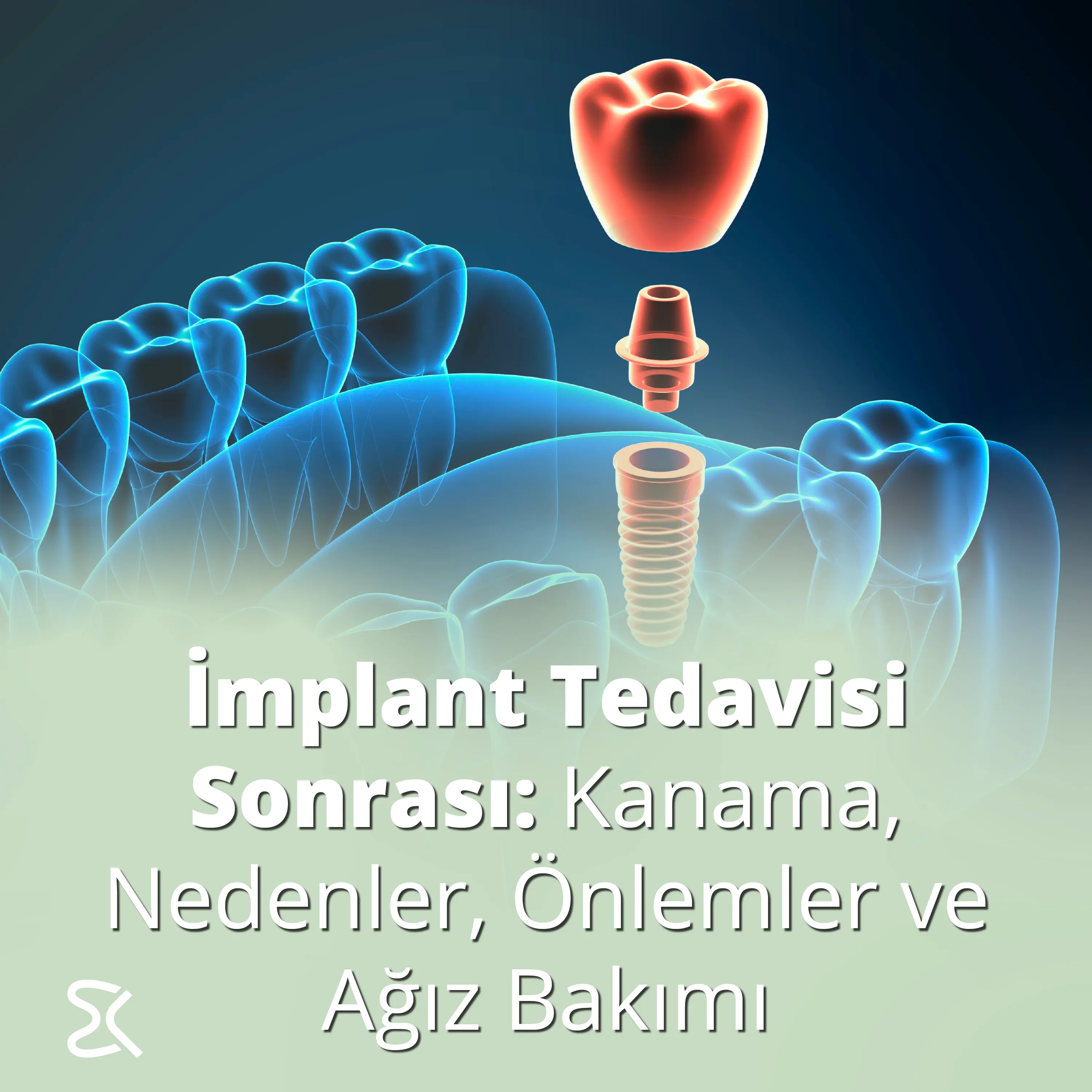 İzmir İmplant Tedavisi Sonrası: Kanama, Nedenler, Önlemler ve Ağız Bakımı Dr. Kutay Gürel Çiğli
