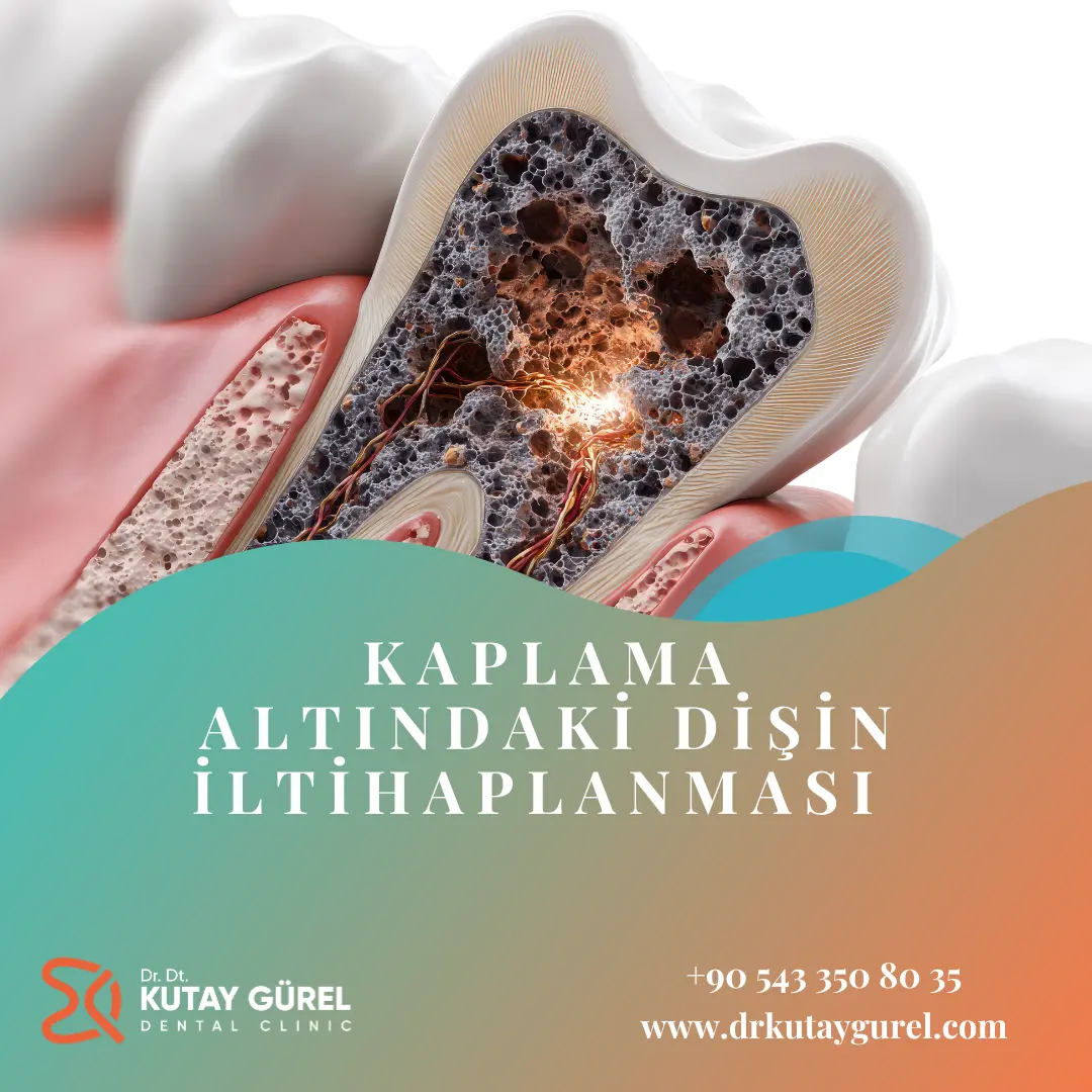 Kaplama Altındaki Dişin İltihaplanması