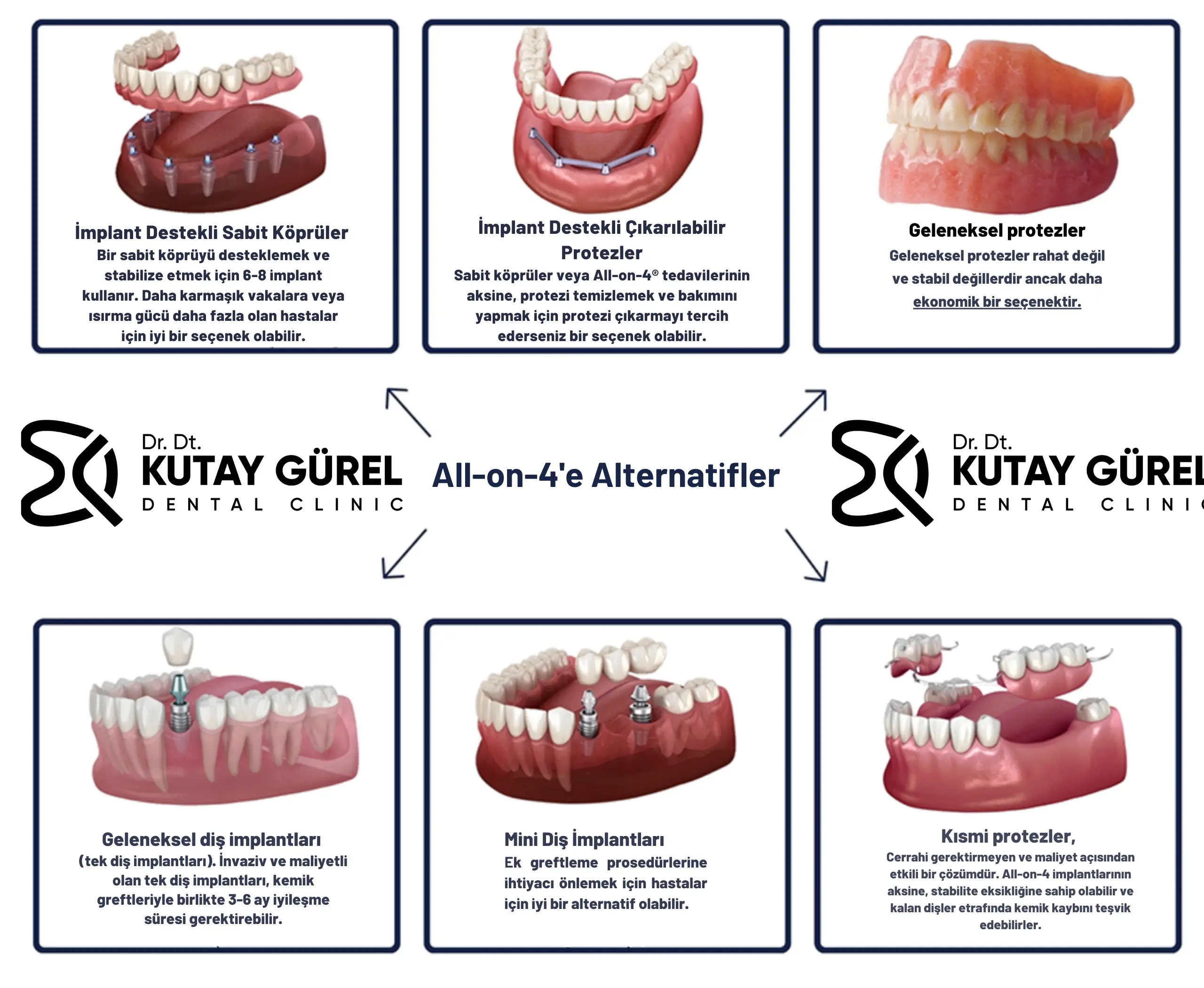 İzmir Çiğli'deki Dr. Dt. Kutay Gürel Diş Kliniği, All-on-Four Dental İmplant Tedavisi ile dişsizlik sorununa kalıcı çözümler sunmaktadır. Bu tedavi, dört adet implantın çene kemiğine yerleştirilmesi ve üzerine sabit diş protezlerinin uygulanması ile yapılır. All-on-Four yöntemi, kemik kaybı yaşayan hastalar için bile etkili bir çözüm sunarak, doğal görünümlü ve fonksiyonel dişler sağlar.