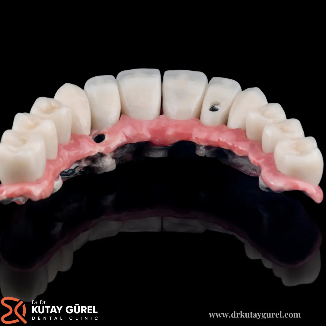 İzmir Çiğli All on Six Diş İmplants Tedavisi, All-on-Six İmplants Dental, İzmir Çiğli En iyi diş doktoru