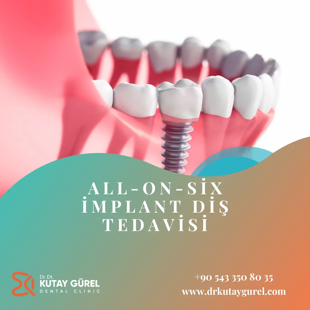 İzmir Çiğli All-on-Six İmplant Diş Tedavisi, All-on-Six İmplants Dental, İzmir Çiğli En iyi diş doktoru