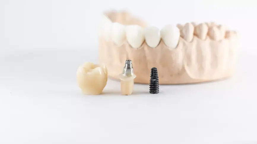 ​ All on Four-All on Six İmplant Diş Tedavi Sonrası Nelere Dikkat Etmek Gerekir izmir cigli- Çiğli İzmir’de All-On-4 implant ve All-On-6 implant tedavisi ile aynı gün sabit dişlere kavuşmak isteyen hastalara, deneyimli diş hekimi Dr. Kutay Gürel tarafından yapılan tam çene implant uygulaması.