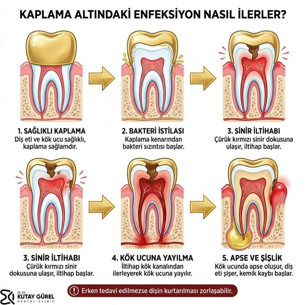 Kaplama Diş Eti Şişmesi