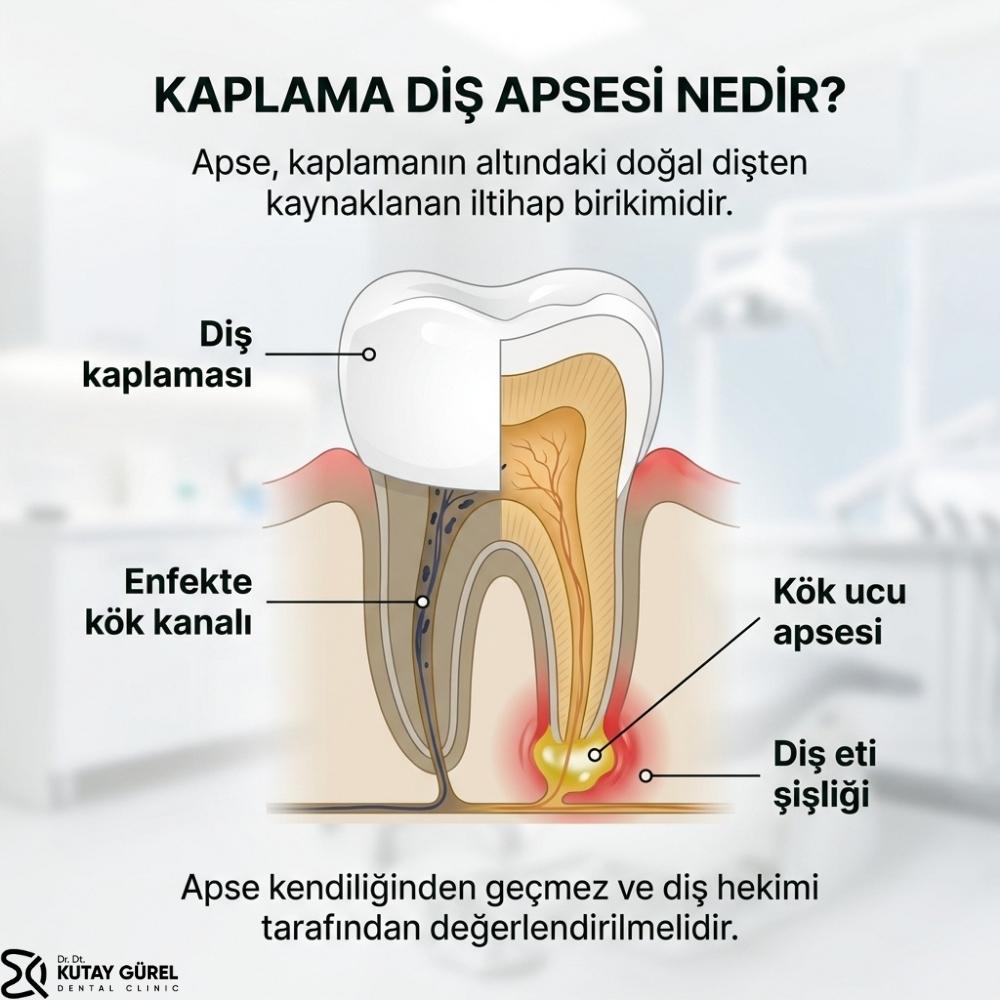 Kaplamanın altındaki ağrıyan dişe ne iyi gelir