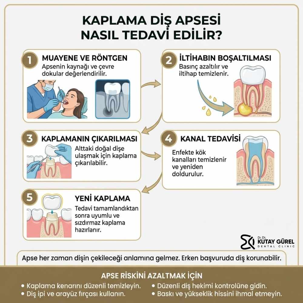 Kaplamanın altındaki diş çürürse ne yapılır