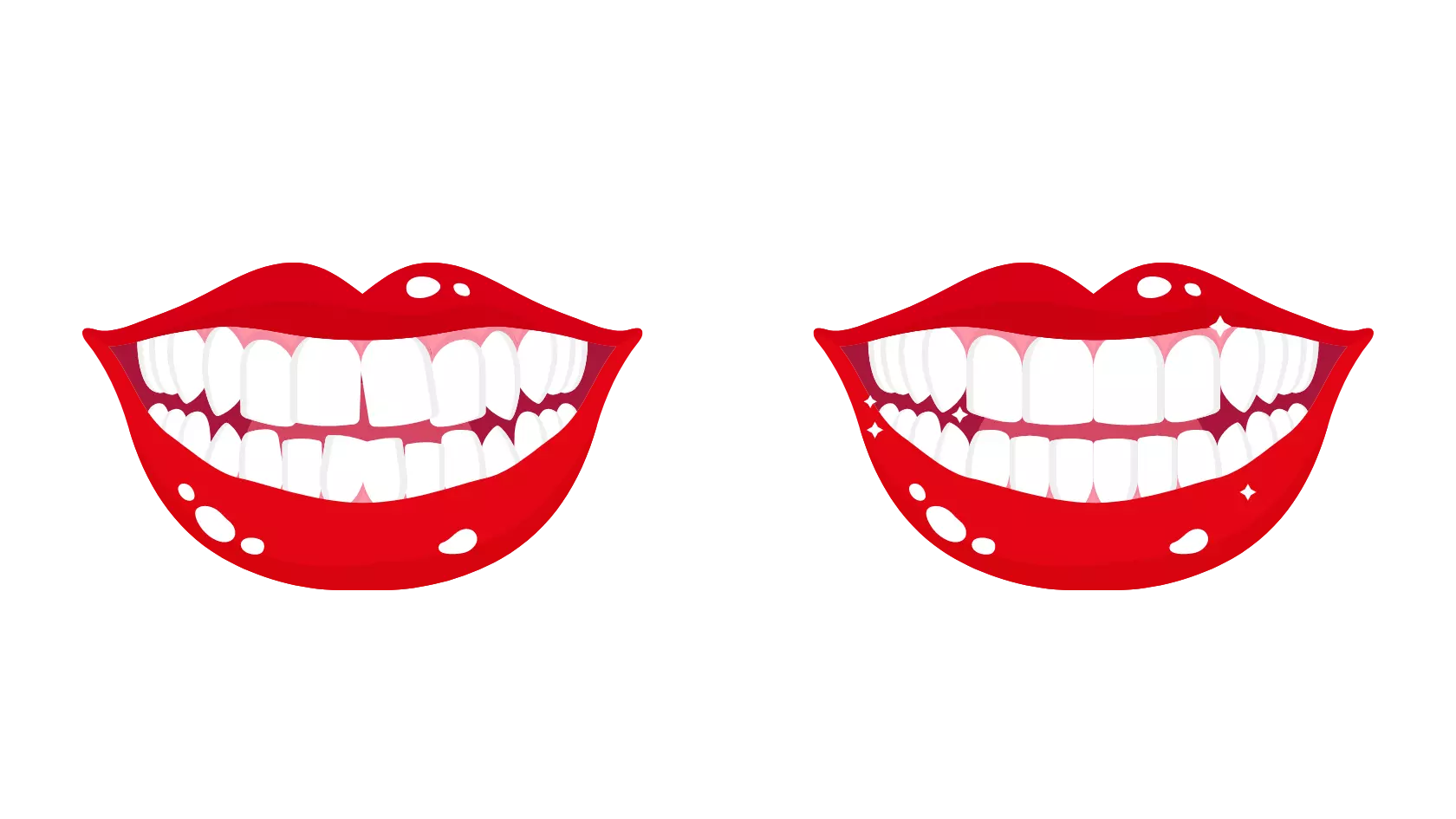 Lamine Diş Kaplama Hangi Durumlarda Uygulanır izmir cigli - Çiğli İzmir en iyi diş doktoru Dr. Kutay Gürel tarafından gerçekleştirilen lamine diş kaplama tedavisi ile hastanın diş rengini ve gülüş estetiğini düzelten uygulama.