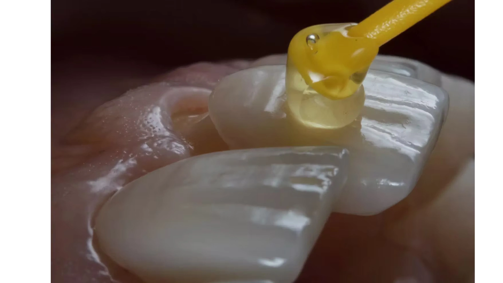 Zirkonyum Diş Kaplama Tedavisi Nasıl Yapılır izmir cigli - Çiğli İzmir en iyi diş doktoru Dr. Kutay Gürel tarafından gerçekleştirilen zirkonyum diş kaplama tedavisi ile kırık, renklenmiş ve form bozukluğu olan dişlerin yenilendiği estetik diş uygulaması.