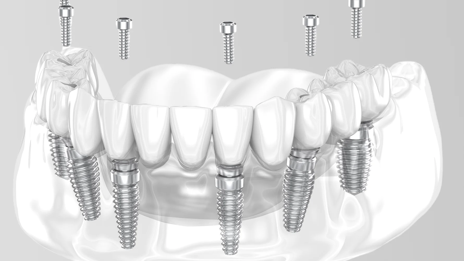 All on Four-All on Six İmplant  izmir cigli - İzmir Çiğli All-On-4 ve All-On-6 diş implantları tedavisi, tam çene sabit implant üstü protez çözümleri sunan Dr. Kutay Gürel Diş Kliniği’nin implant planlama ve uygulama fotoğrafı.