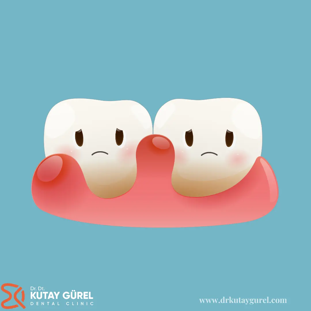 İzmir Çiğli En iyi diş doktoru Dr.Dt. Kutay Gürel Diş Kliniği diş etinde diş çıkması