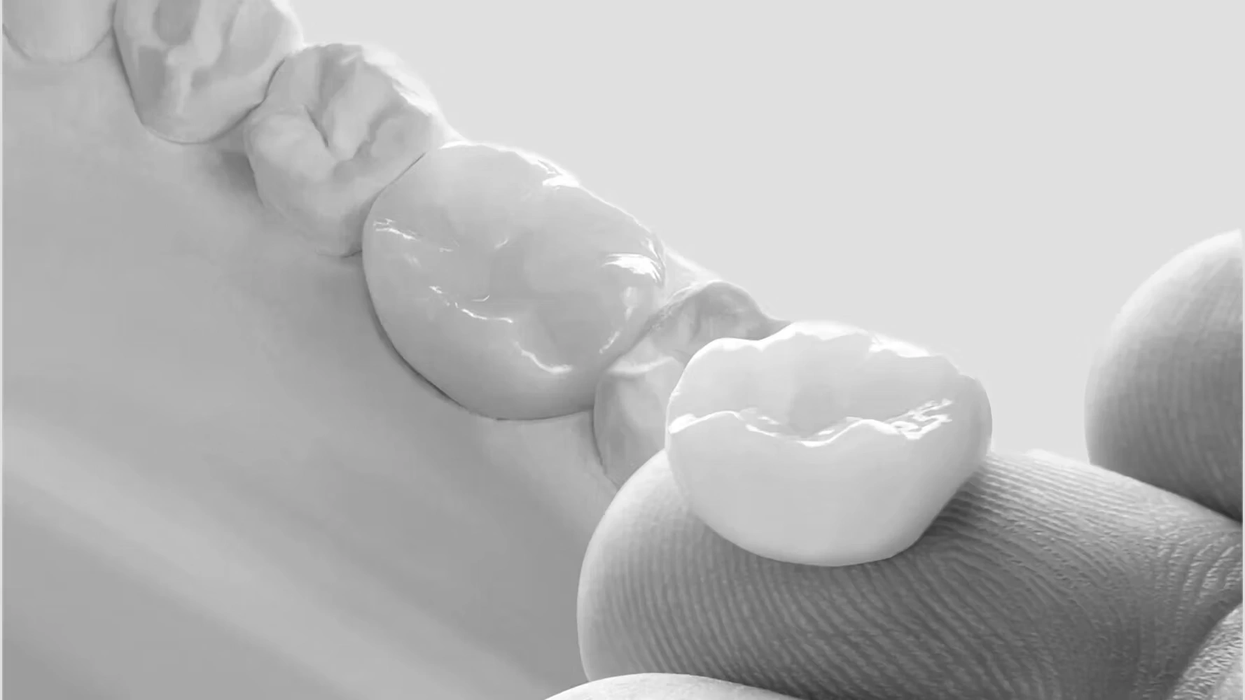  E-max ve Empress  izmir cigli - Çiğli İzmir’de ön diş estetiği için E-Max diş ve Empress kaplama tercih eden hastaya, en iyi diş hekimlerinden Dr. Kutay Gürel tarafından yapılan estetik kaplama tedavisi.