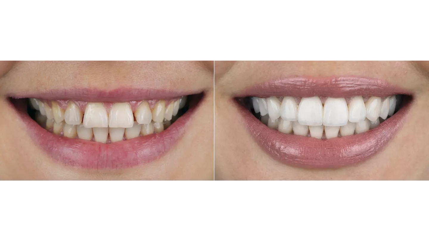 Zirkonyum Diş Kaplamaları Hangi Durumlarda izmir cigli - İzmir Çiğli zirkonyum diş kaplama tedavisi, doğal diş görünümüne yakın estetik sonuçlar sunan ve uzun ömürlü kaplamalarla gülüş tasarımı sağlayan Dr. Kutay Gürel Diş Kliniği.
