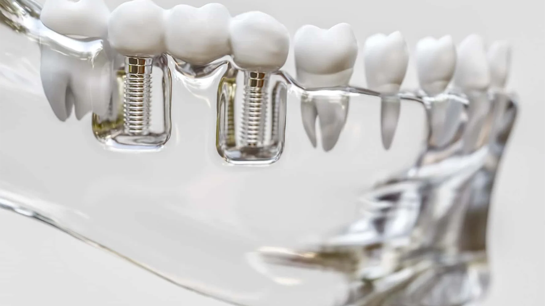 izmir cigli İmplant Nasıl Yapılır - İzmir Çiğli diş implantı tedavisi ile eksik diş sorununa kalıcı çözüm sağlayan Dr. Kutay Gürel Diş Kliniği’nde, hastaya implant planlama ve uygulama aşamasını gösteren fotoğraf.