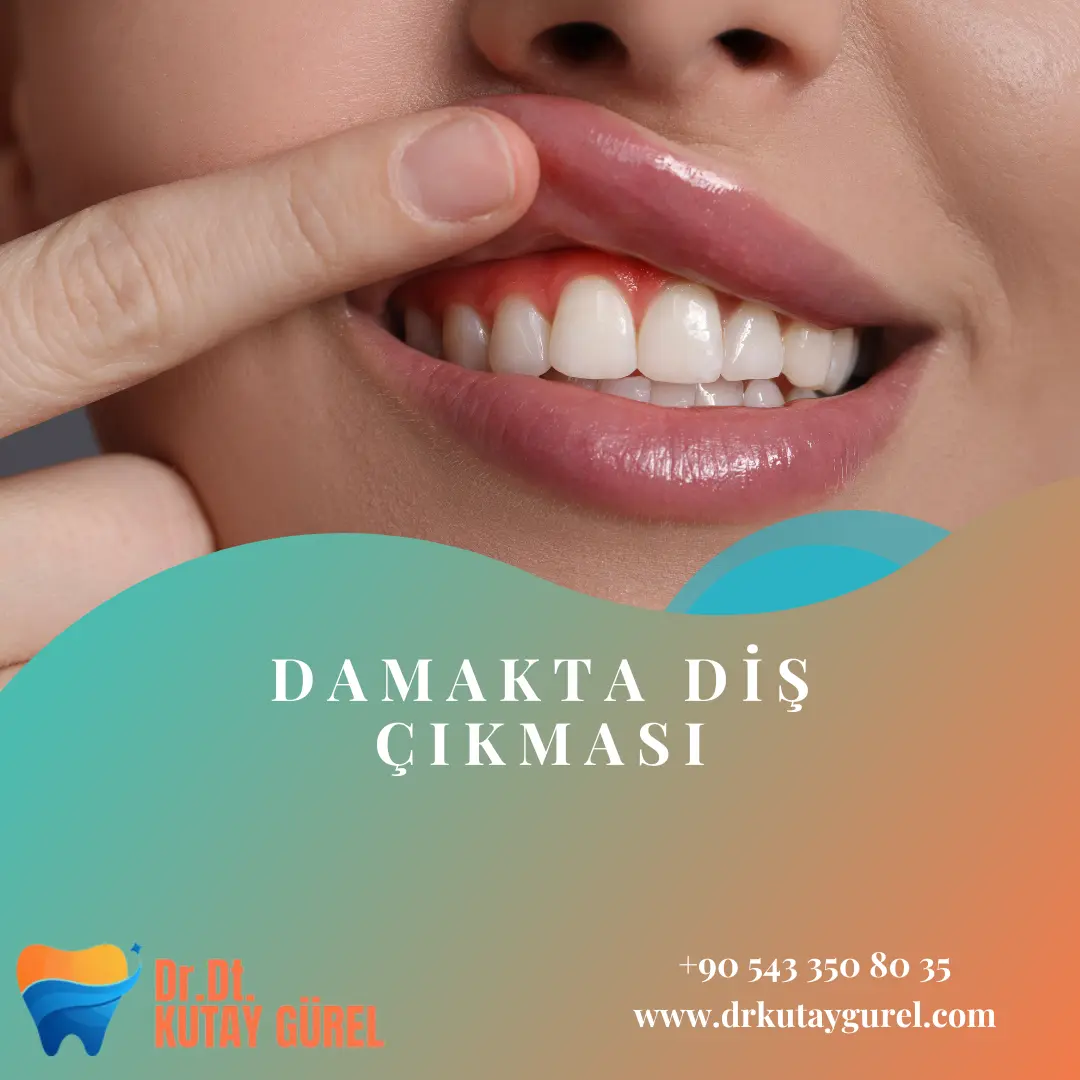İzmir Çiğli En iyi diş doktoru Damakta Diş Çıkması