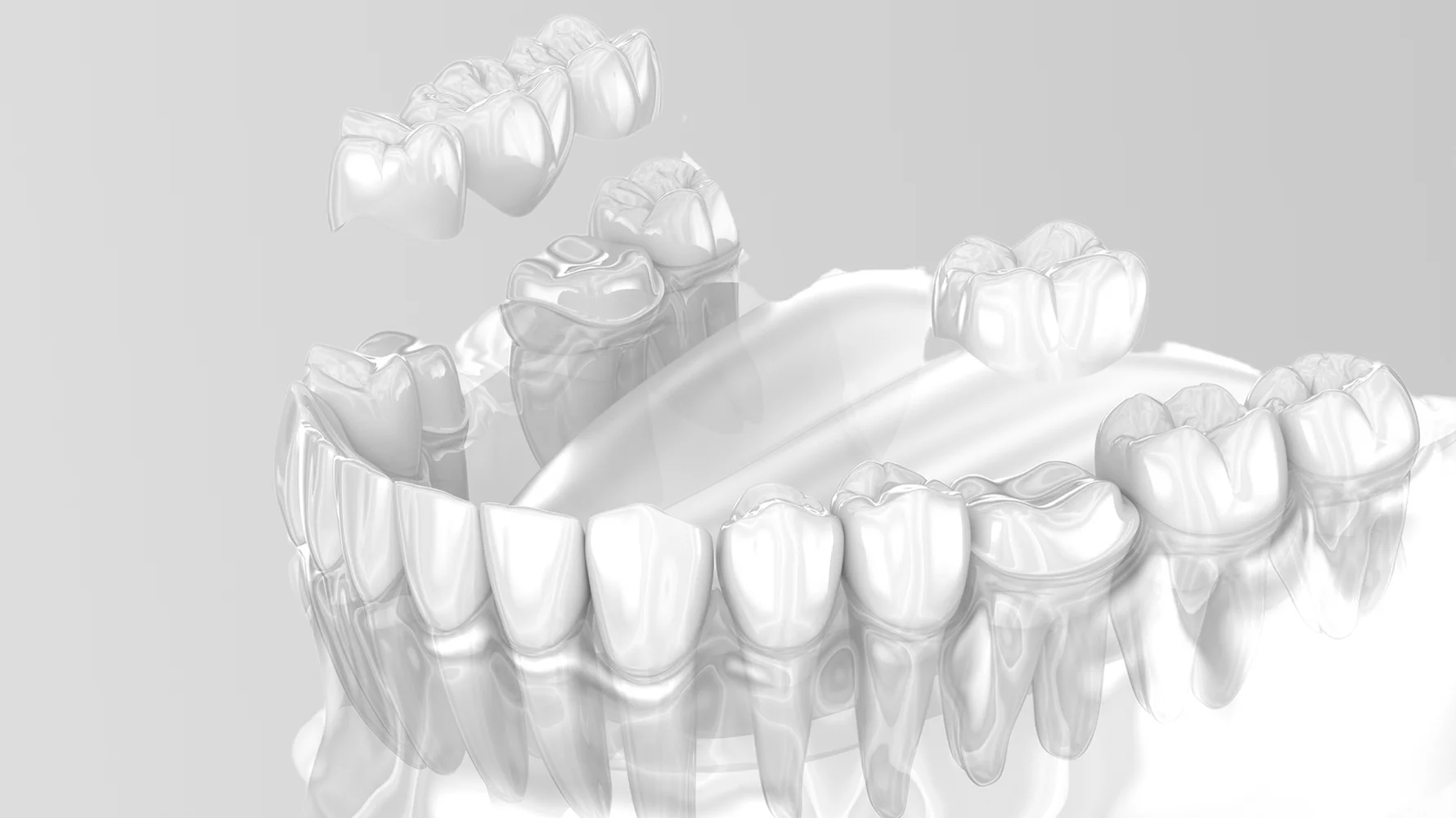 İzmir Çiğli kanal tedavisi için başvuran hastaya, uzman diş hekimi Dr. Kutay Gürel tarafından uygulanan kök kanal tedavisi ve dişi koruyucu tedavi fotoğrafı.