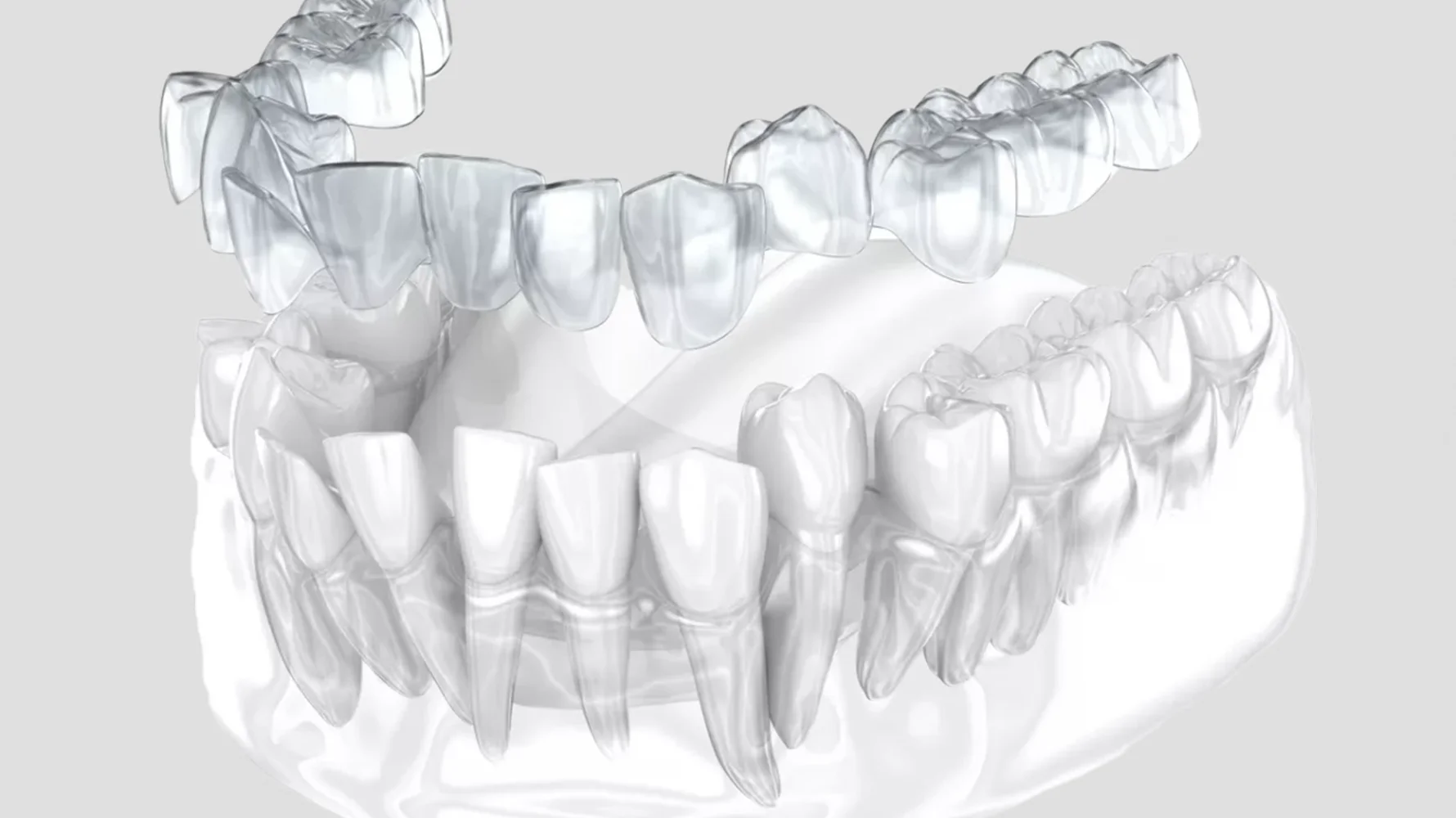Lamine Diş Kimlere Uygulanmaz izmir cigli - İzmir Çiğli lamine diş kaplama tedavisi, ince porselen laminalar ile diş şeklini ve rengini düzelten estetik diş hekimliği uygulaması, Dr. Kutay Gürel Diş Kliniği.