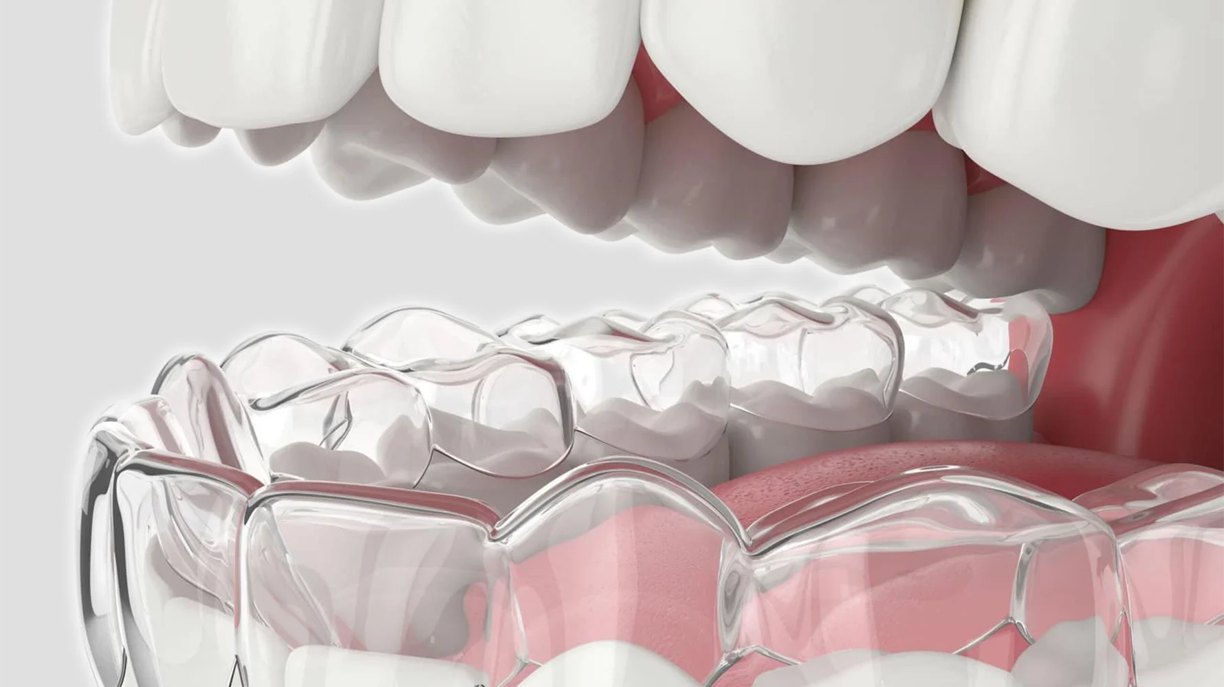 İzmir Çiğli en iyi diş doktoru Dr. Kutay Gürel tarafından planlanan ortodonti tedavisi, metal diş teli ve şeffaf plak seçenekleriyle gülüş estetiği sağlayan diş kliniği fotoğrafı.