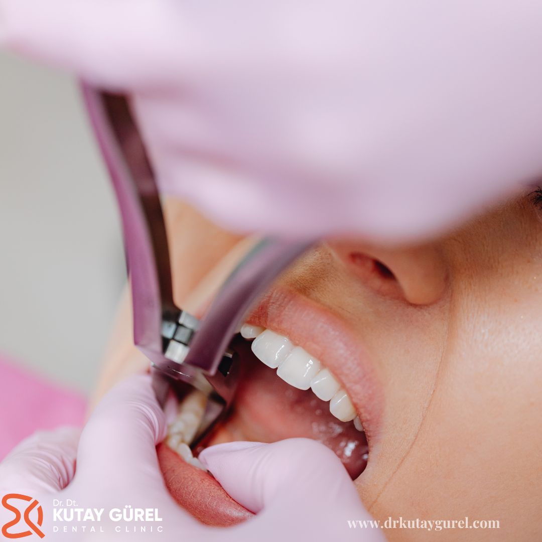 İzmir Sadece Kökü Kalan Diş Tedavisi