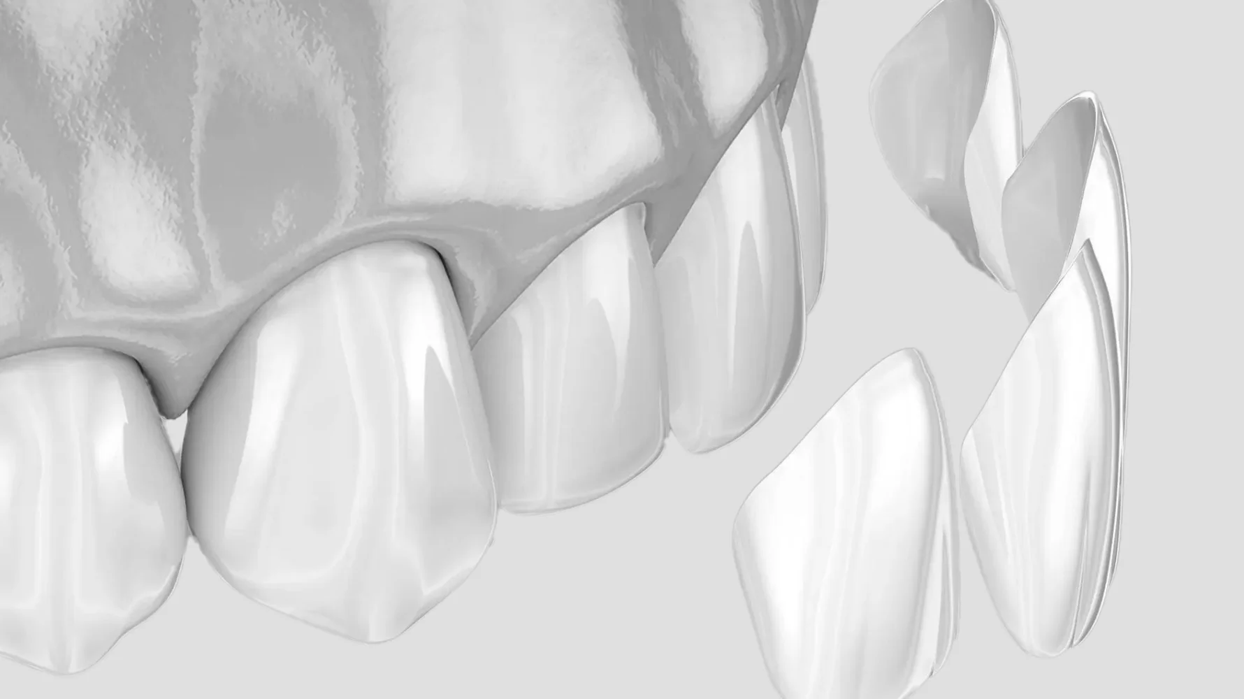 Zirkonyum Diş Kaplama izmir cigli - İzmir Çiğli’de zirkonyum diş kaplama, porselen üstü zirkonya altyapı ve doğal ışık geçirgenliği ile estetik gülüş sağlayan Dr. Kutay Gürel’in modern diş kliniği tedavi görüntüsü.