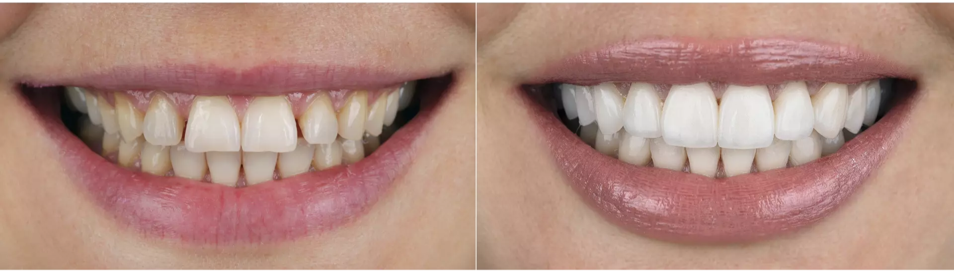 emax diş kaplama izmir cigli - Çiğli İzmir en iyi diş doktoru Dr. Kutay Gürel tarafından uygulanan E-Max diş kaplama ve Empress porselen kaplama ile doğal ve beyaz gülüş elde eden hasta.